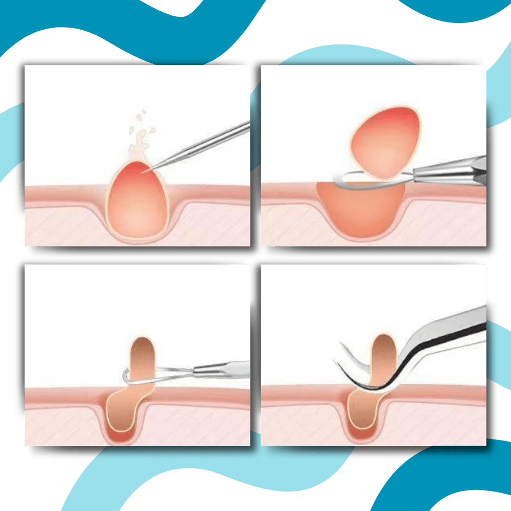 Präzisionspinzette zur Entfernung von Mitessern