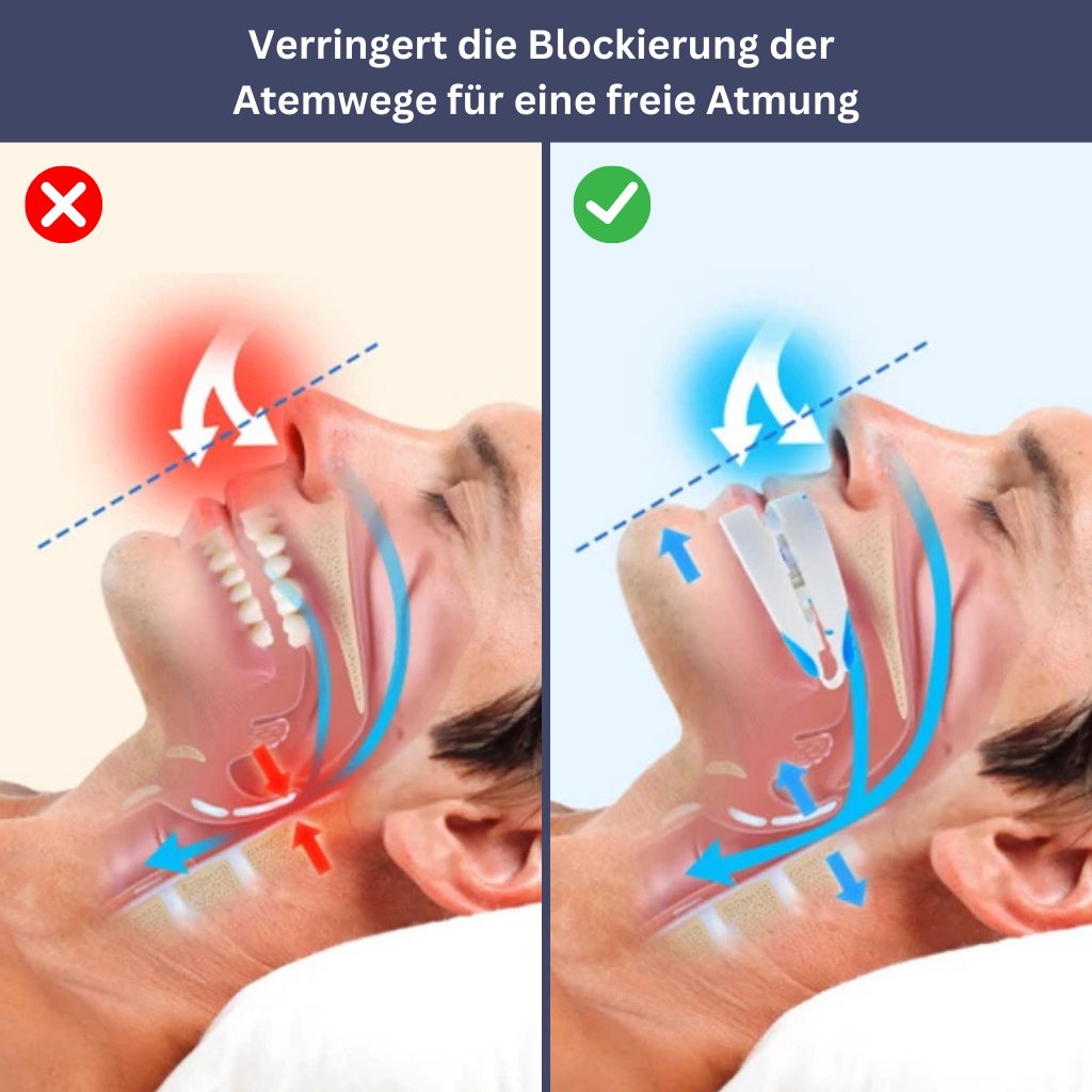 Anti-Schnarch- und Kieferausrichtungsgerät