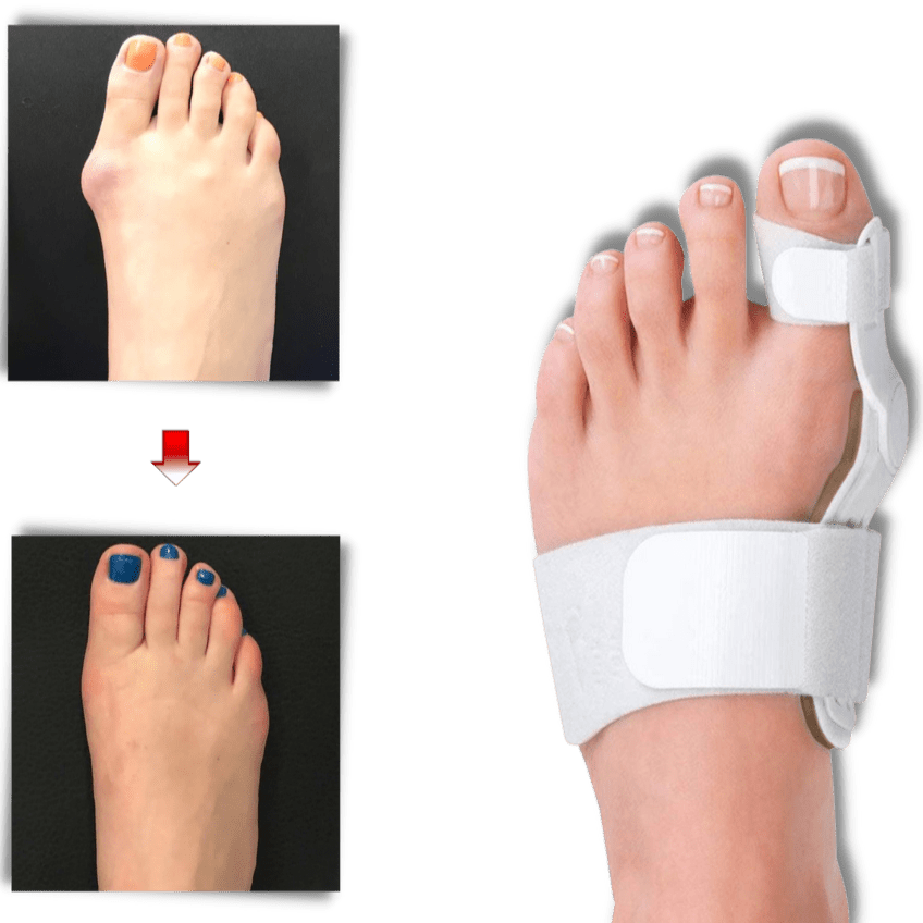 Orthopädischer Hallux Valgus Korrektor zur Schmerzlinderung