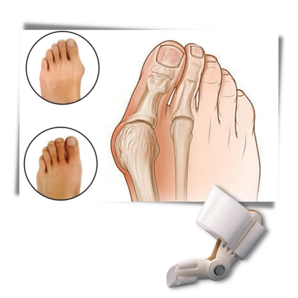 Orthopädischer Hallux Valgus Korrektor zur Schmerzlinderung