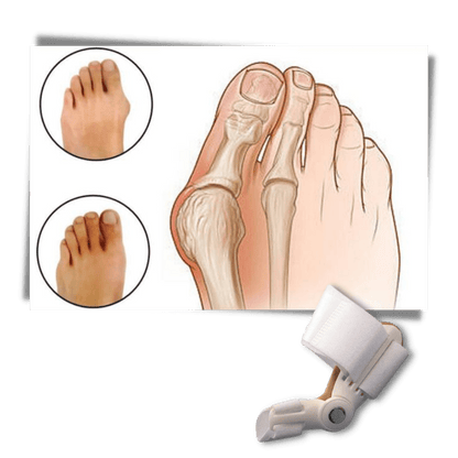 Orthopädischer Hallux Valgus Korrektor zur Schmerzlinderung