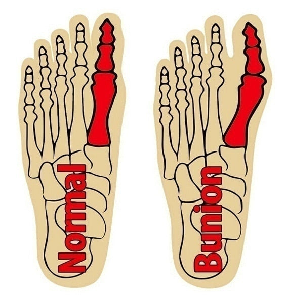 Podi-Care Bunion & Hallux Valgus Korrektor