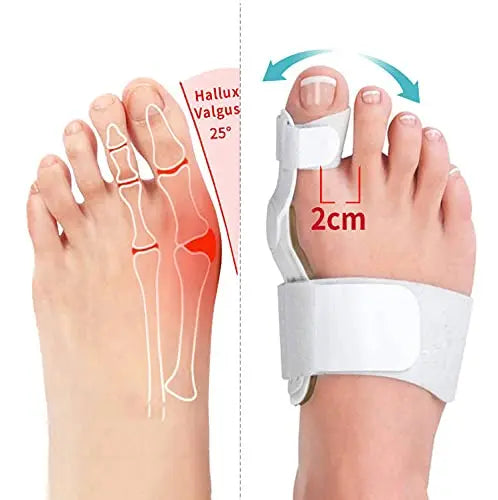 Orthopädischer Hallux Valgus Korrektor zur Schmerzlinderung