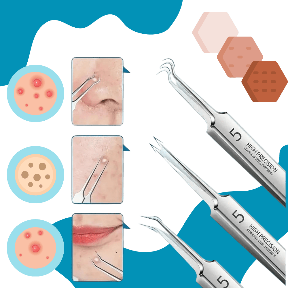 Präzisionspinzette zur Entfernung von Mitessern