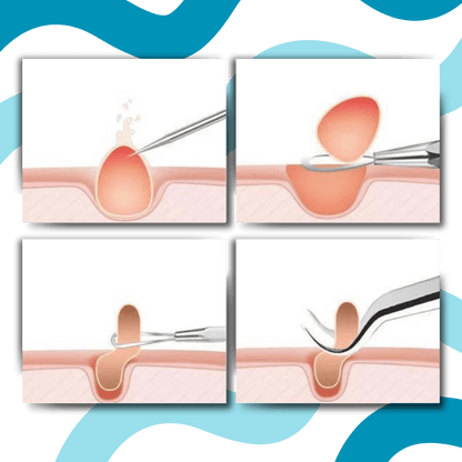 Präzisionspinzette zur Entfernung von Mitessern
