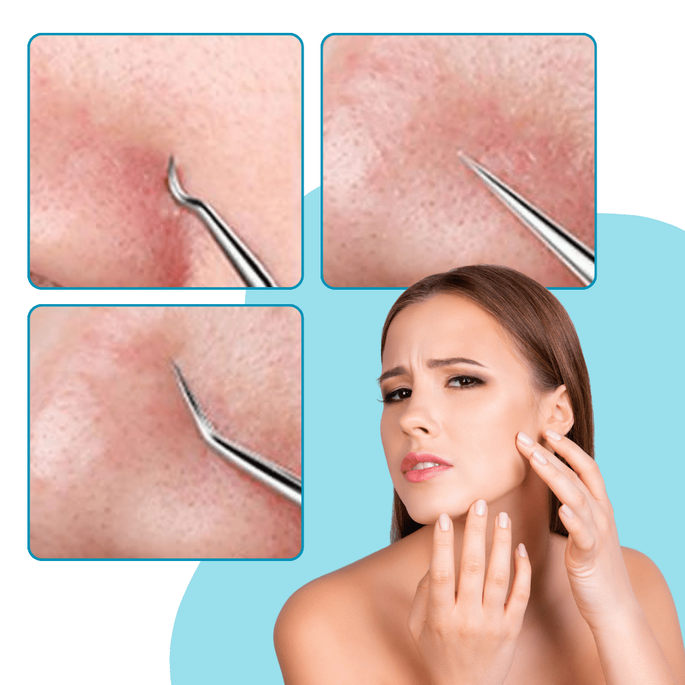 Präzisionspinzette zur Entfernung von Mitessern