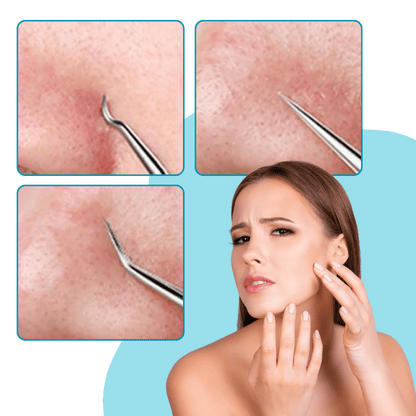 Präzisionspinzette zur Entfernung von Mitessern